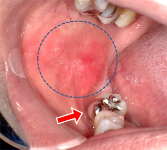 頬粘膜に発赤とびらん