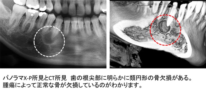 骨形成繊維種摘出術症例ケース１