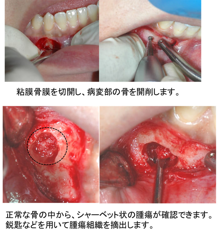 骨形成繊維種摘出術症例ケース２