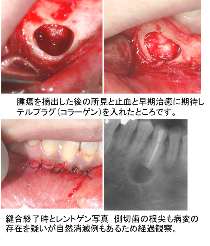 骨形成繊維種摘出術症例ケース３