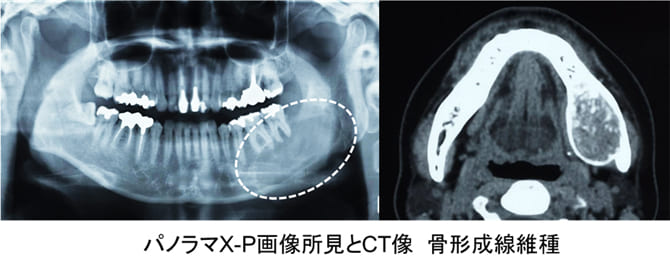 低侵襲な骨形成繊維種摘出術症例ケース１