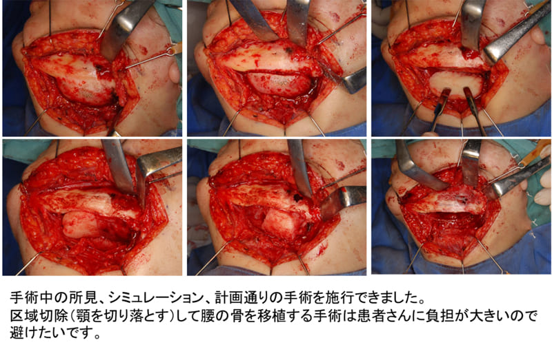 低侵襲な骨形成繊維種摘出術症例ケース２