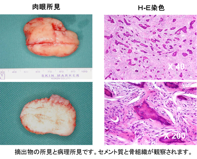 低侵襲な骨形成繊維種摘出術症例ケース３