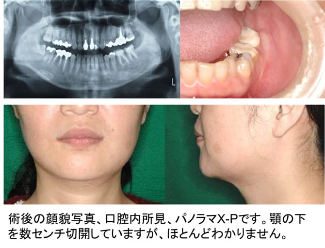 低侵襲な骨形成繊維種摘出術症例ケース４