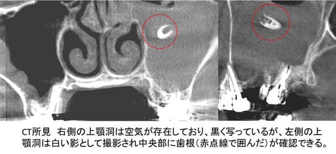 上顎洞内歯牙（歯根）迷入症例ケース１