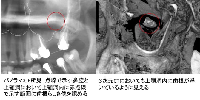 上顎洞内歯牙（歯根）迷入症例ケース２