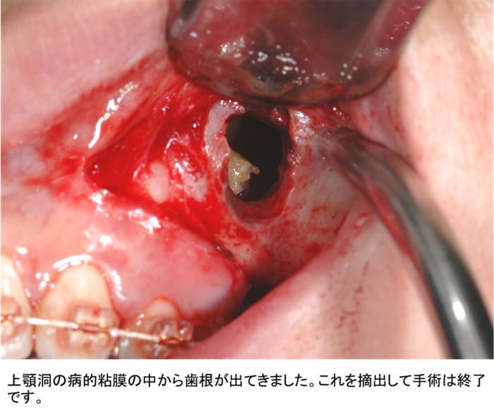 上顎洞内歯牙（歯根）迷入症例ケース４