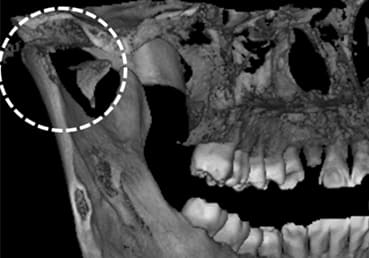 顎関節突起骨折