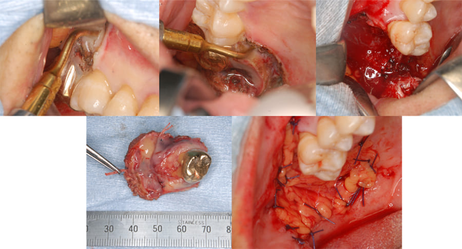顎骨腫瘍切除への応用