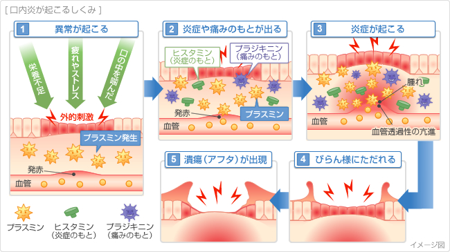 口内炎のできるまで